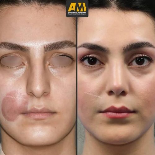 Rhinoplasty-116