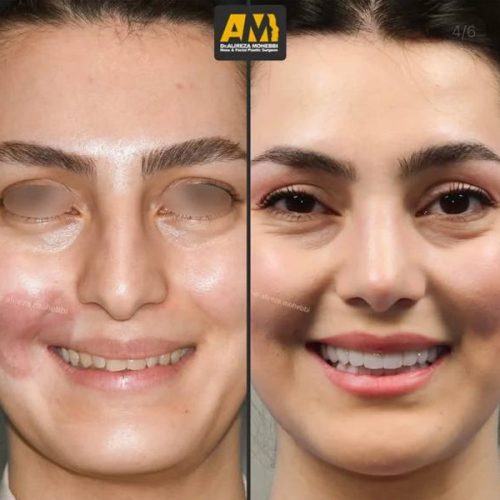 Rhinoplasty-117
