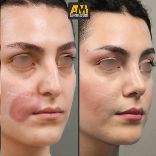 Rhinoplasty-118
