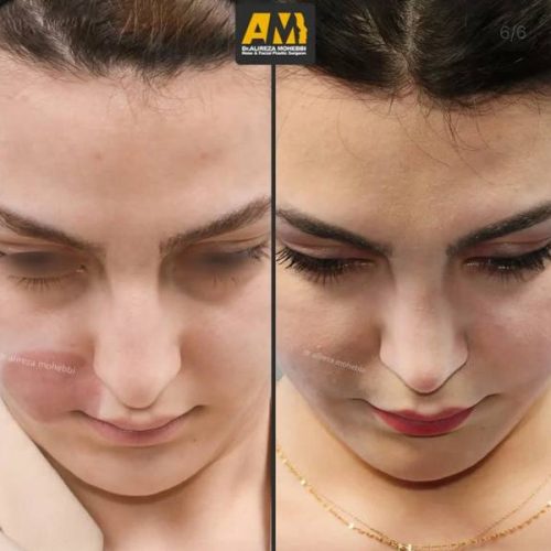 Rhinoplasty-119