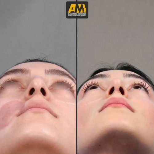 Rhinoplasty-120
