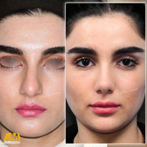 Rhinoplasty-121