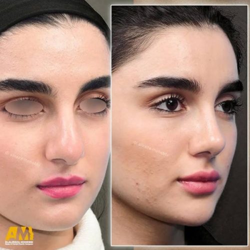 Rhinoplasty-122