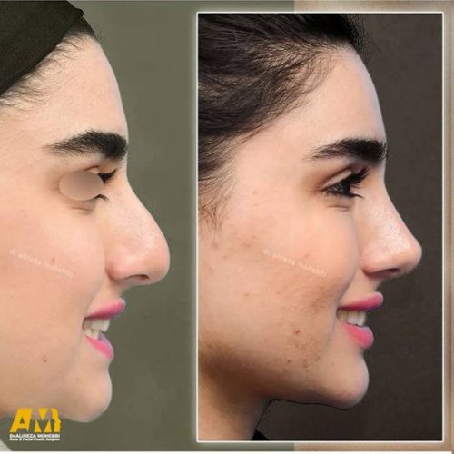 Rhinoplasty-123