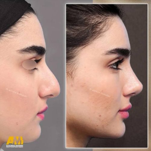 Rhinoplasty-124