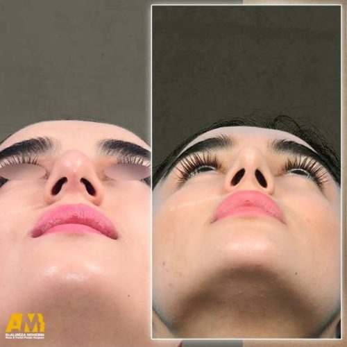 Rhinoplasty-125