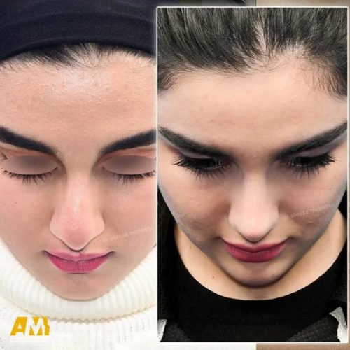 Rhinoplasty-126
