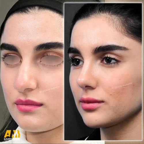 Rhinoplasty-127