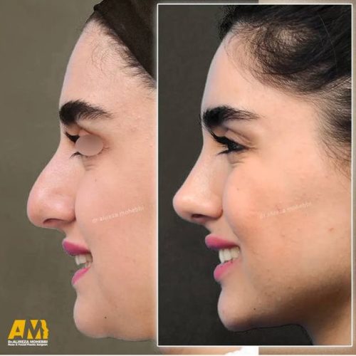 Rhinoplasty-128
