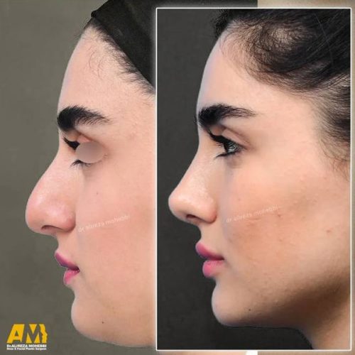 Rhinoplasty-129
