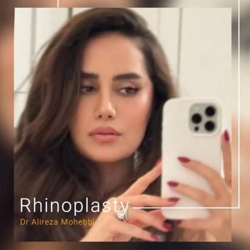 Rhinoplasty-132