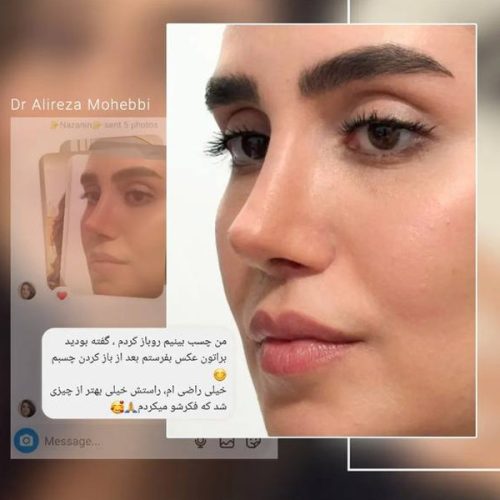 Rhinoplasty-133