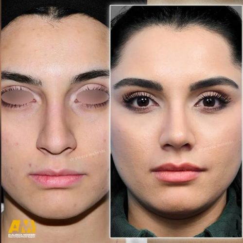 Rhinoplasty-134