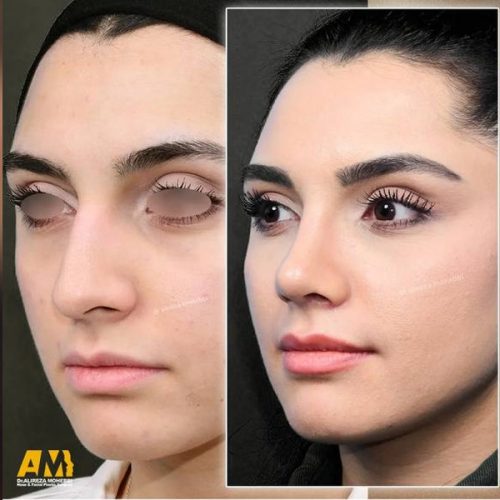 Rhinoplasty-135