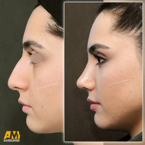Rhinoplasty-136