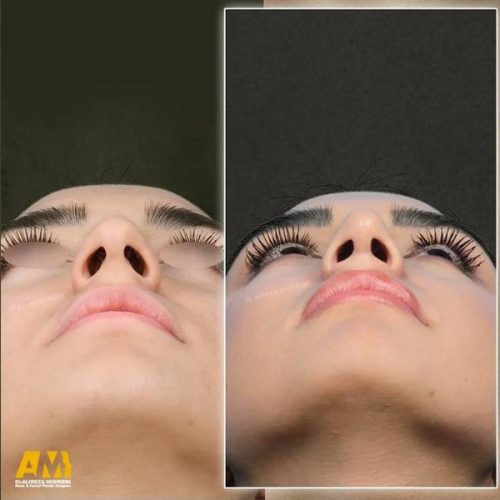 Rhinoplasty-137