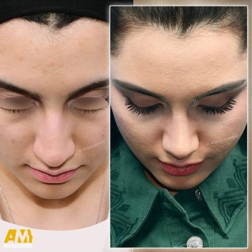 Rhinoplasty-138