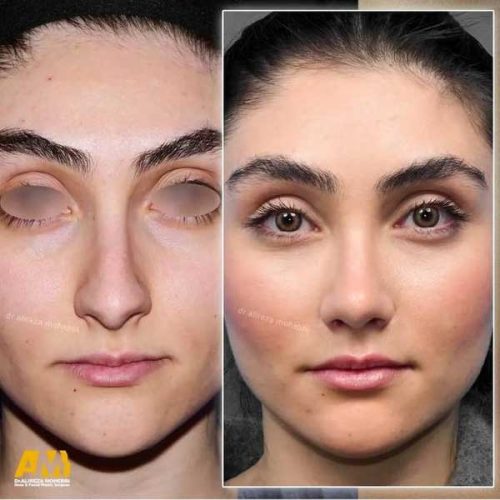 Rhinoplasty-139