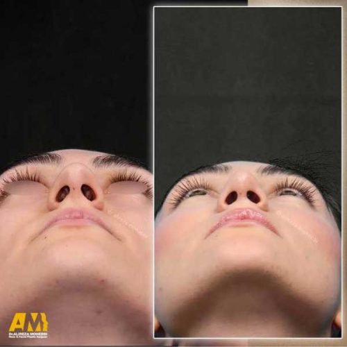 Rhinoplasty-140