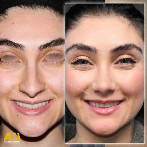 Rhinoplasty-141
