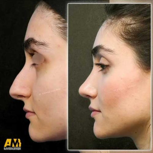 Rhinoplasty-142