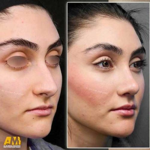 Rhinoplasty-143