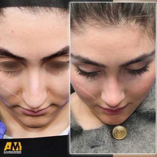 Rhinoplasty-144