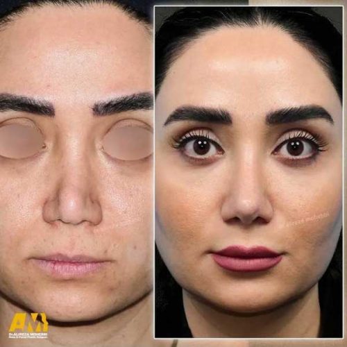 Rhinoplasty-145