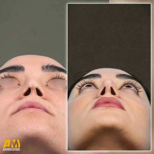 Rhinoplasty-146