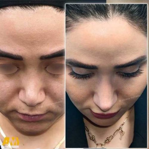 Rhinoplasty-147
