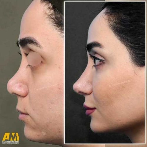 Rhinoplasty-148
