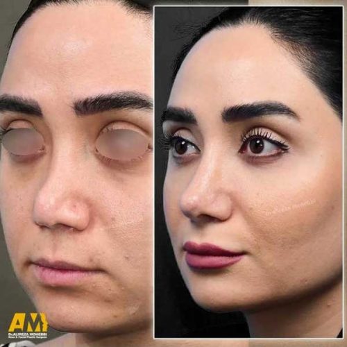 Rhinoplasty-149
