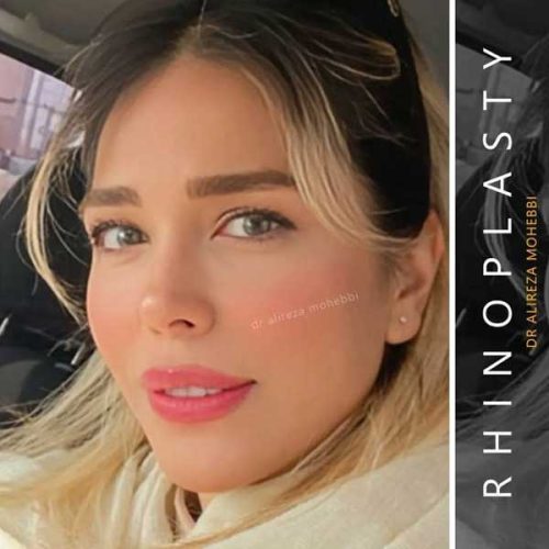 Rhinoplasty-150