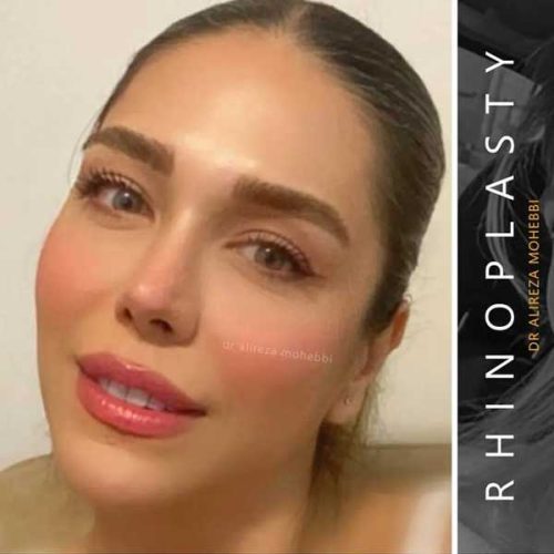 Rhinoplasty-151