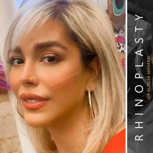 Rhinoplasty-152
