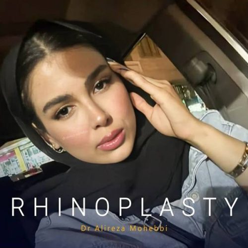 Rhinoplasty-154