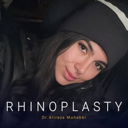 Rhinoplasty-155