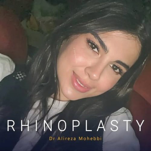 Rhinoplasty-156