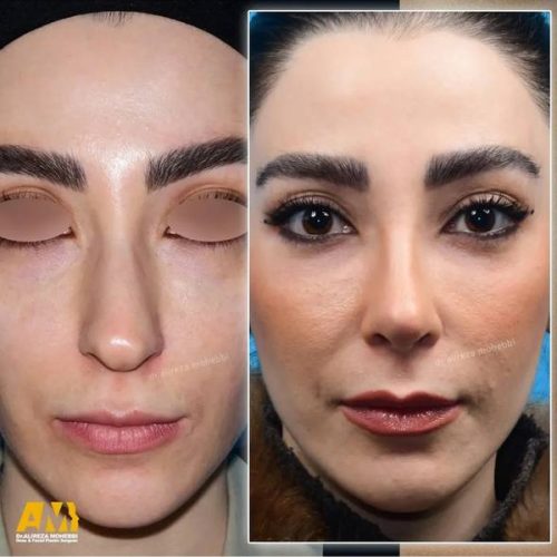 Rhinoplasty-157