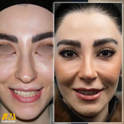 Rhinoplasty-158