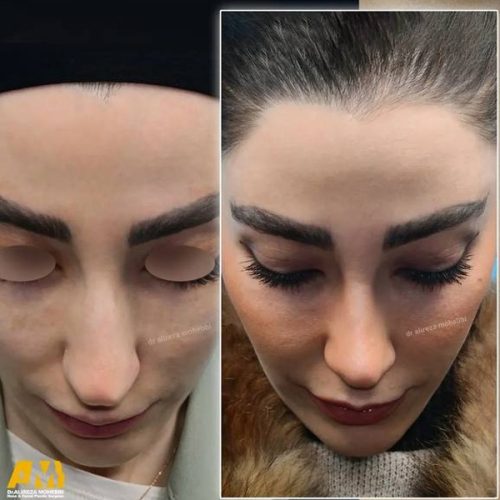 Rhinoplasty-159