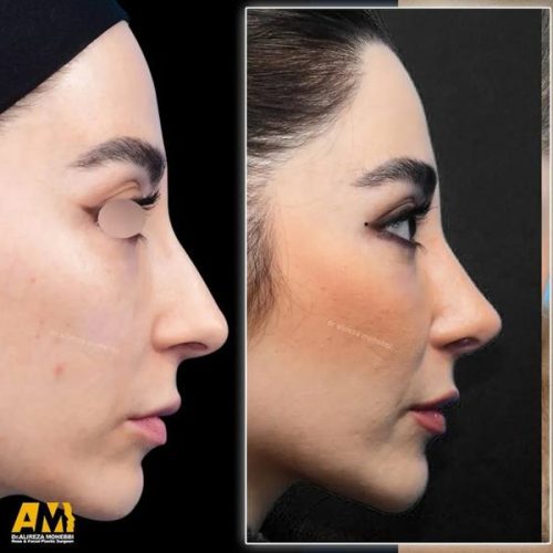 Rhinoplasty-160