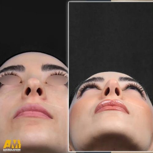 Rhinoplasty-161
