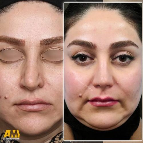 Rhinoplasty-162
