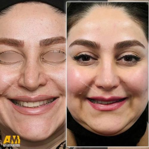 Rhinoplasty-163