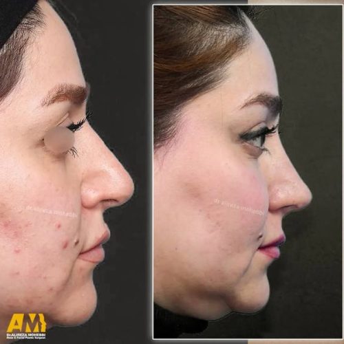 Rhinoplasty-164