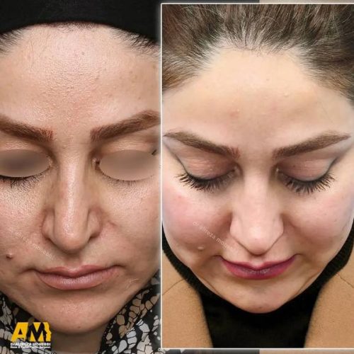 Rhinoplasty-165