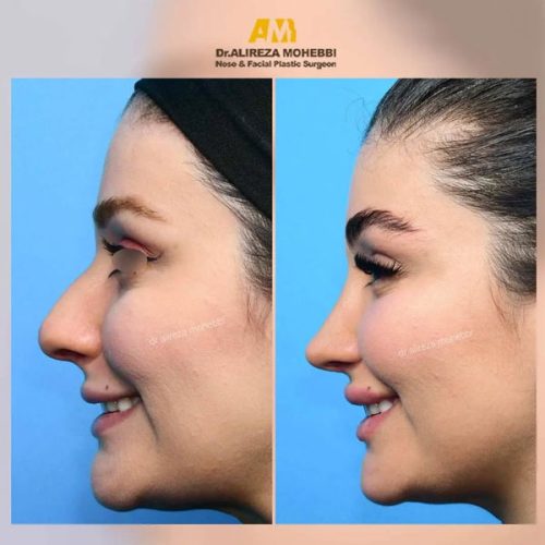 Rhinoplasty-43