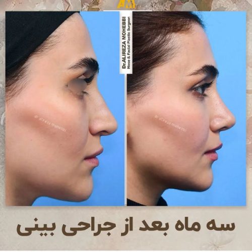 Rhinoplasty-45