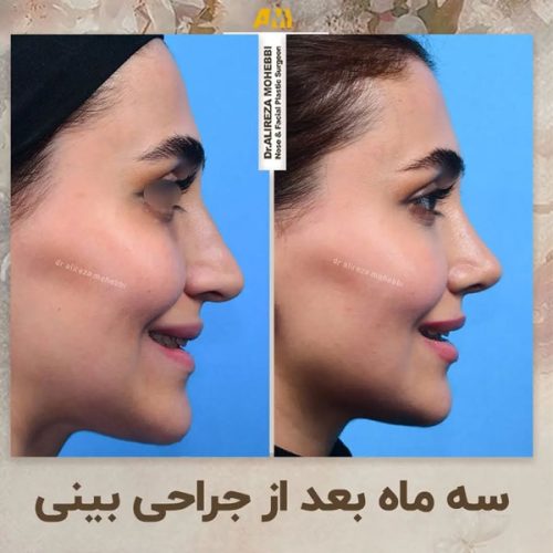 Rhinoplasty-48